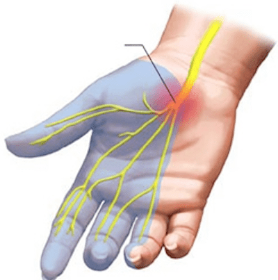 3carpaltunnel.png