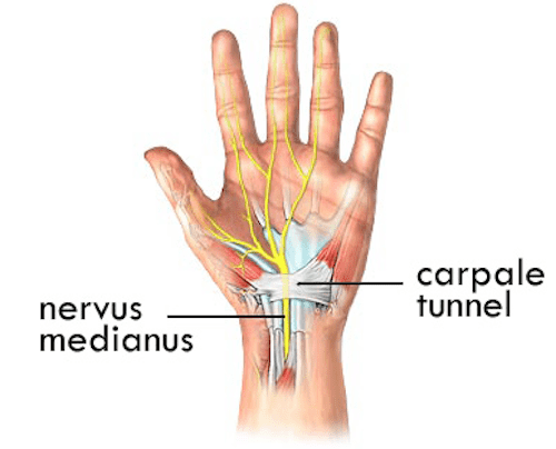 4carpaltunnel.png