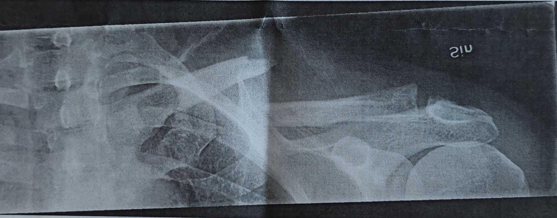 Clavicel.jpg