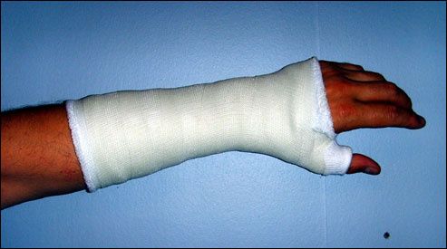 [1/2 OT]Gips av - skena på (äckelbilder) | Happyride