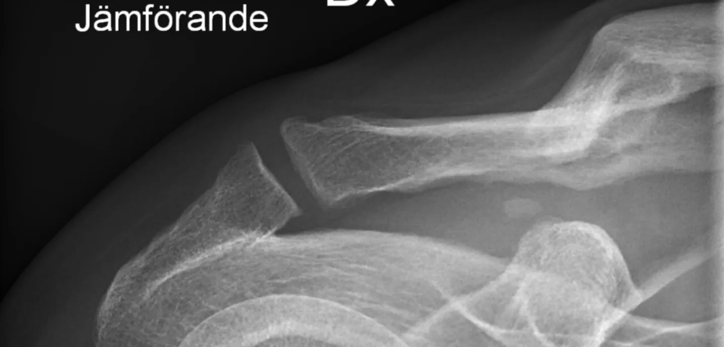 Nyckelben höger läkt.webp