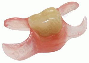 one-tooth-valplast-300x212.gif