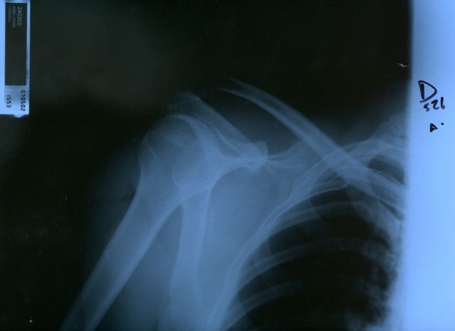 shoulder.jpg ht=465
