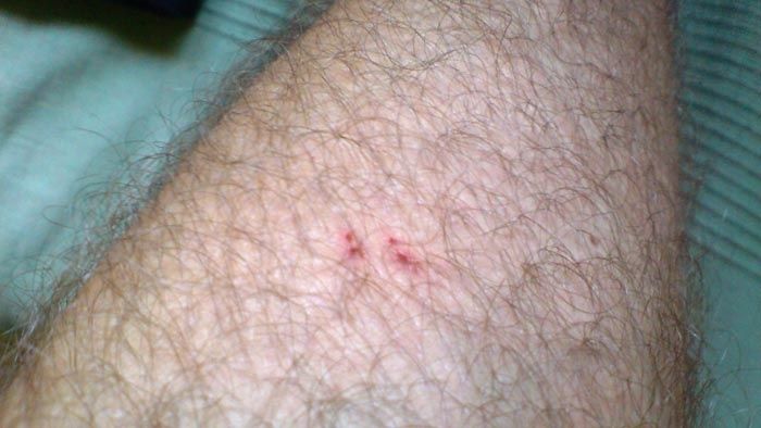 snakebite.jpg ht=394