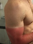 Solbränna.jpg