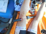 bar-through-leg-680px.jpg