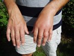 svullen hand 2006.JPG