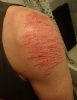 skrubbsår-axel.jpg
