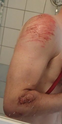 alex-och-armbåge.jpg