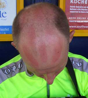 sunburn3.jpg