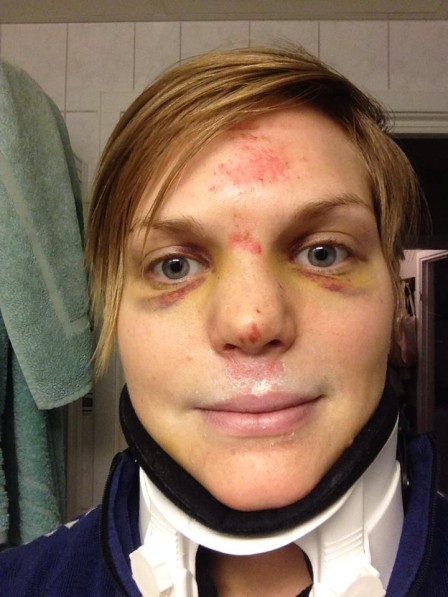 Nackkragar kan behövas i vissa lägen, till exempel om en landar på ansiktet och får frakturer på nackutskotten.